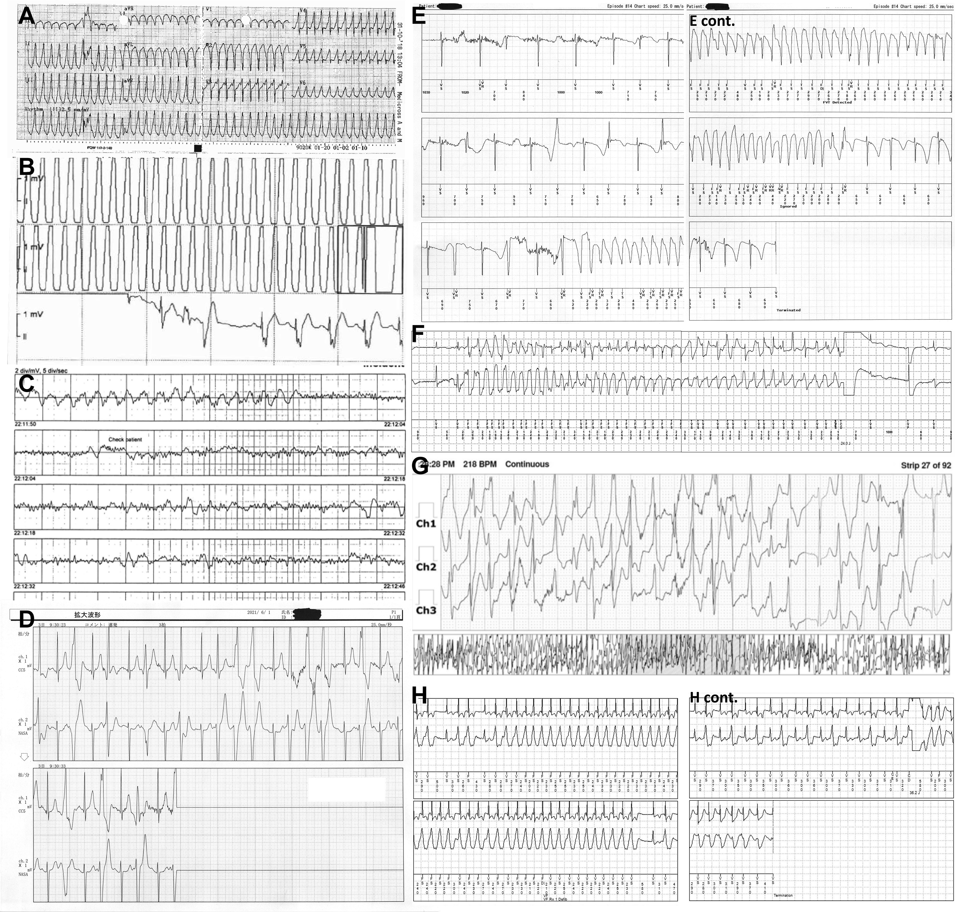 heart arrhythmia examples from study